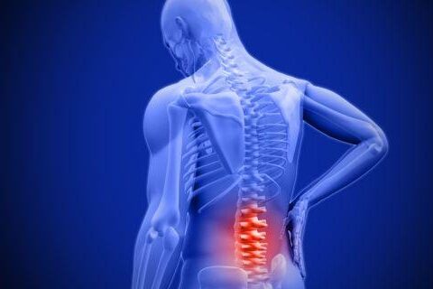 LUMBAR CANAL STENOSIS